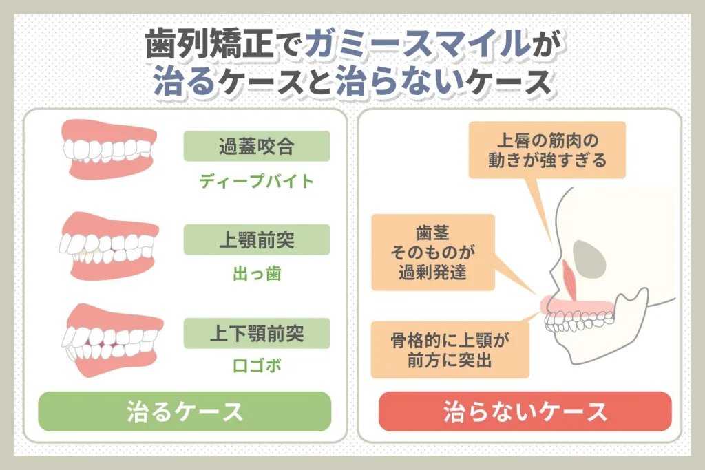 ガミースマイルは歯列矯正で治るケース、治らないケース