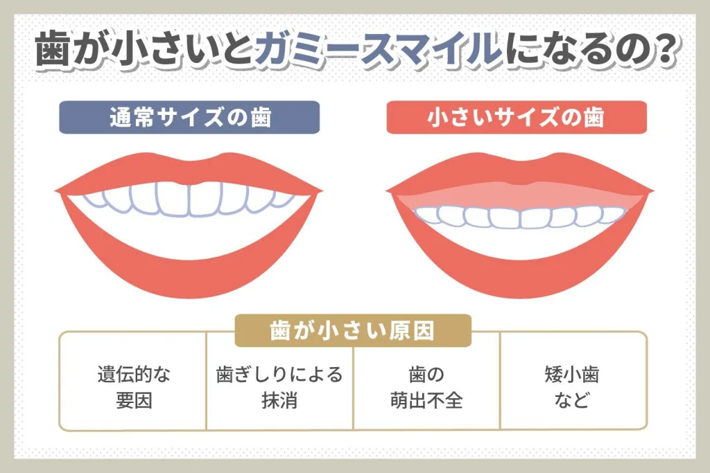 歯が小さいとガミースマイルになる？