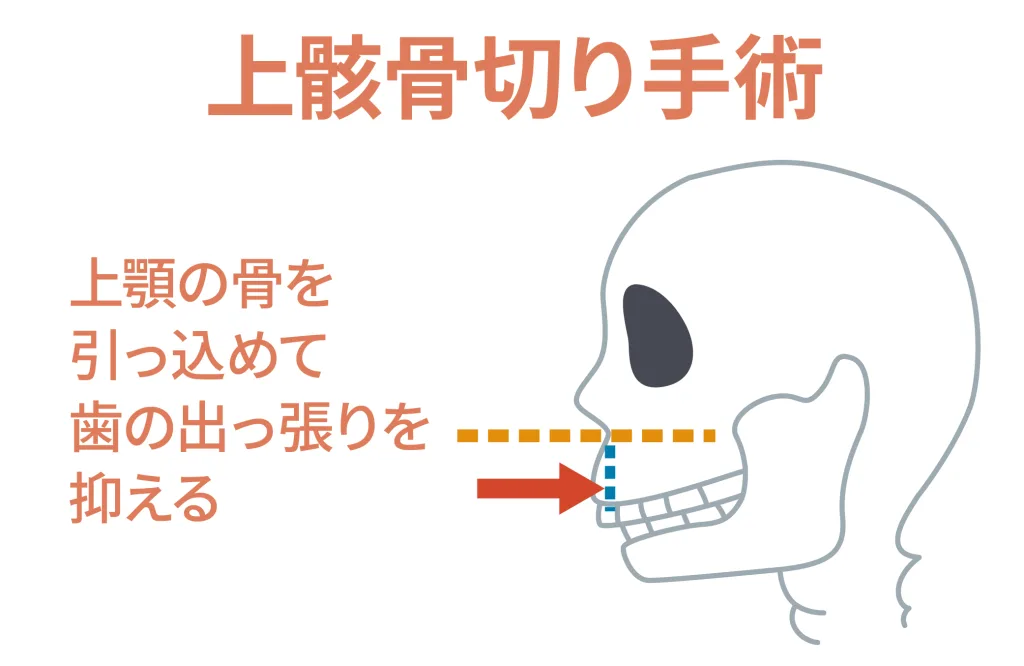 上顎骨切り手術