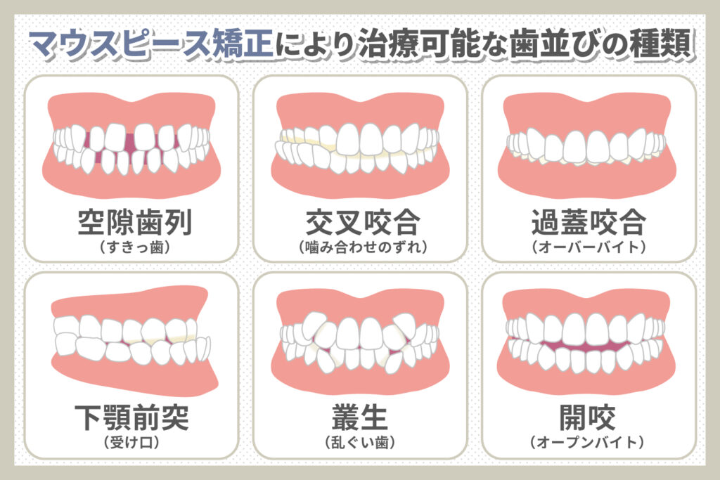 マウスピース矯正によって治療できる歯並びの種類