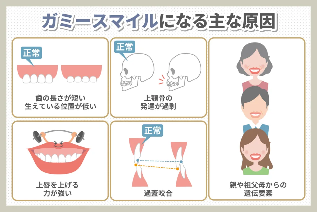 ガミースマイルになる主な原因