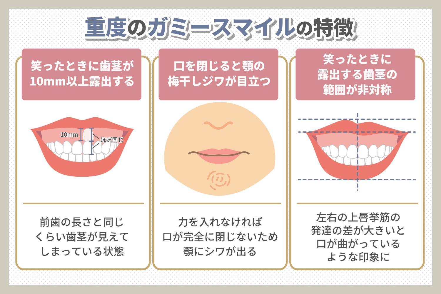 重度のガミースマイルの特徴は？重度のガミースマイルを放置するデメリットや主な治療法を解説